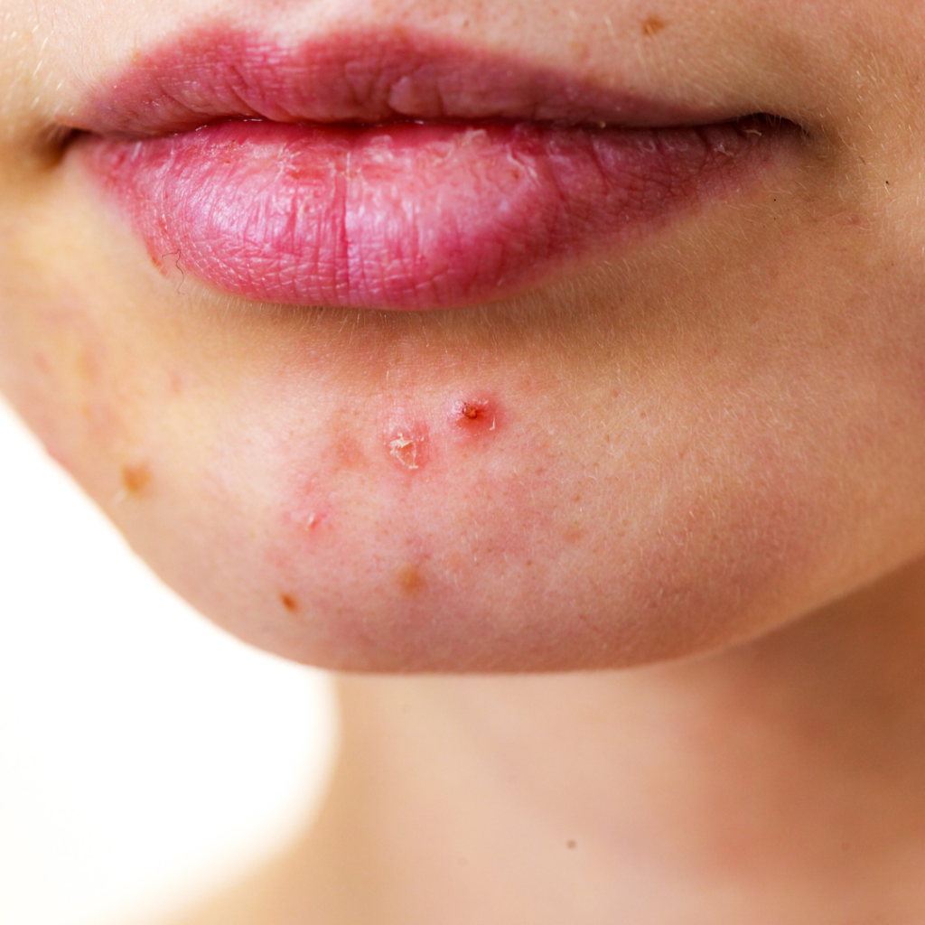 Is Your Persistent Acne Caused By Hyperandrogenism? | Skin Fit Well